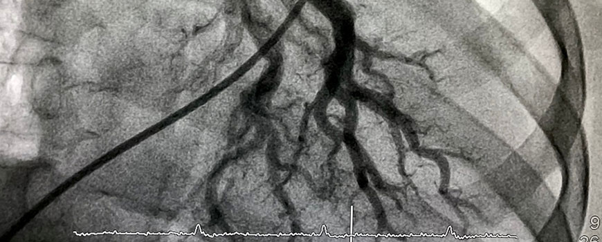 artery embolization