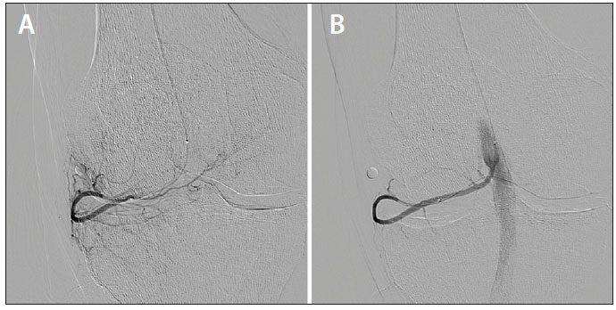 geniculate artery embolization (GAE) comparison