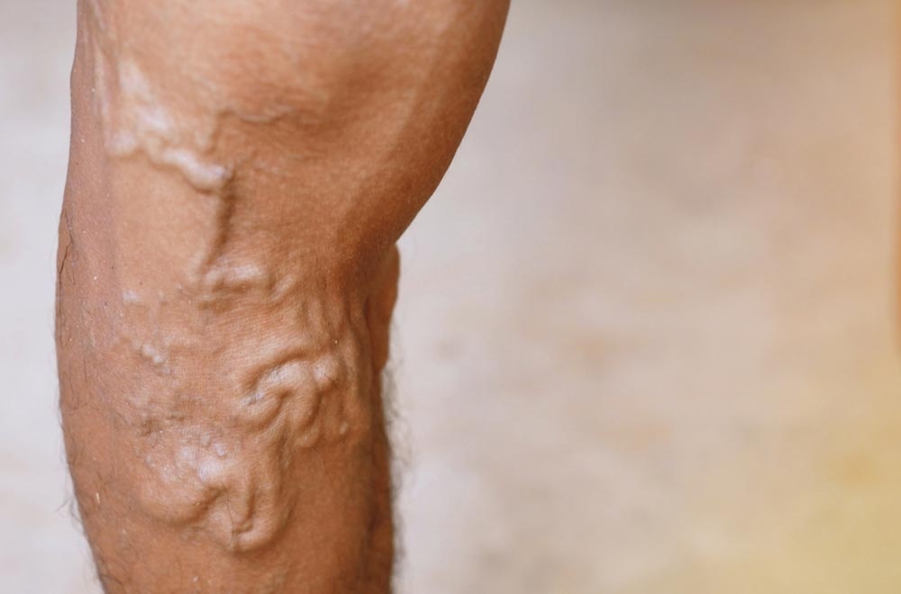 Varicose vein treatment — varicose veins signs symptoms and treatment in muslim society fearured image | Prof. Dr. Imtiaz Ahmad, interventional radiologist