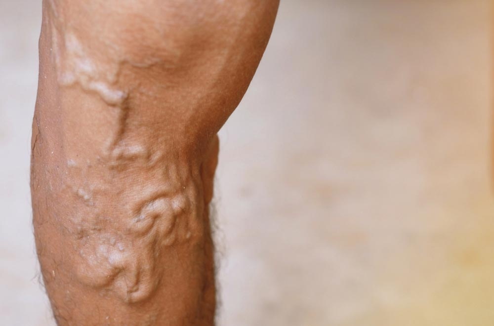 Varicose Veins: Signs, Symptoms and Treatment in a Muslim Society Dr Imtiaz Ahmad