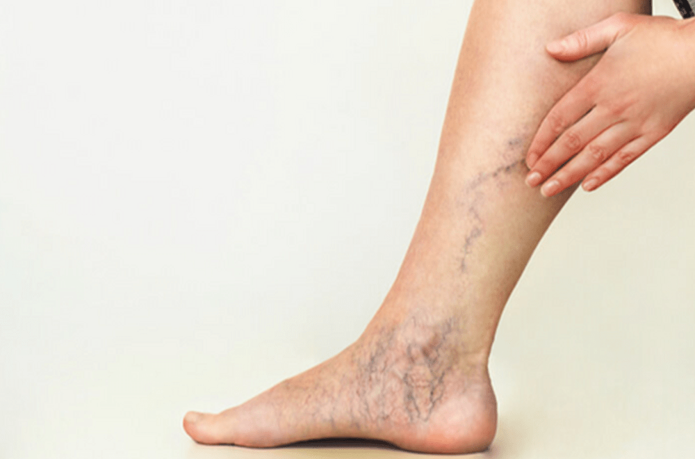 Can venous leaks be cured naturally?