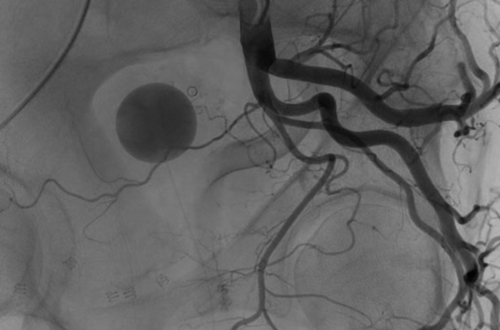how long does prostate artery embolization last