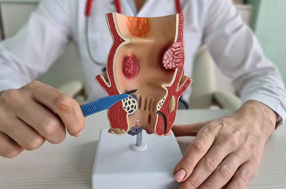 hemorrhoid artery embolization