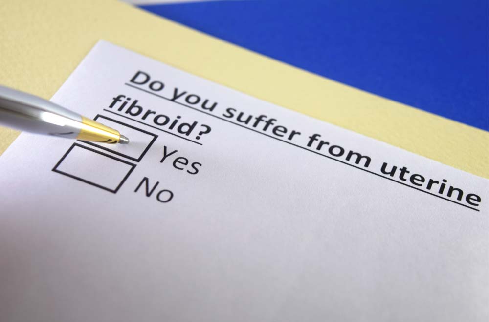 Uterine fibroid embolization (UFE) — all about fibroids causes symptoms treatment and types featured image | Prof. Dr. Imtiaz Ahmad, interventional radiolo