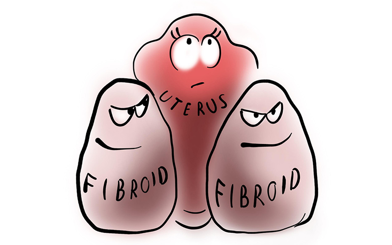Uterine fibroid embolization (UFE) — bidding goodbye to fibroids and adenomyosis a novel treatment strategy image two | Prof. Dr. Imtiaz Ahmad, interventio