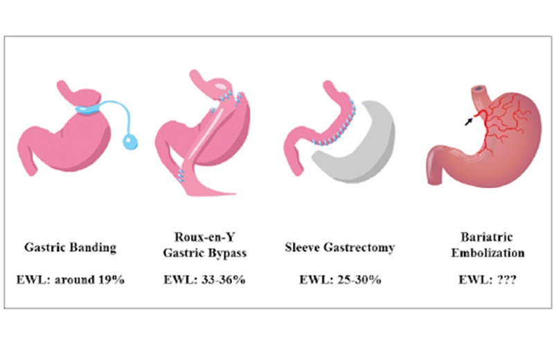 Bariatric arterial embolization — a trouble free obesity treatment nanoblock bariatricarterial embolization image one | Prof. Dr. Imtiaz Ahmad, interventio
