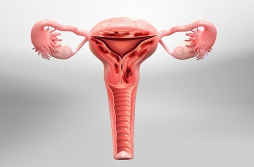 Adenomyosis treatment — adenomyosis its causes and treatment featured image | Prof. Dr. Imtiaz Ahmad, interventional radiologist Pakistan