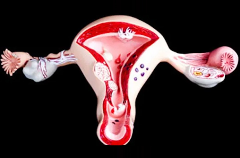 Adenomyosis treatment — adenomyosis important bits that you should know featured image | Prof. Dr. Imtiaz Ahmad, interventional radiologist Pakistan