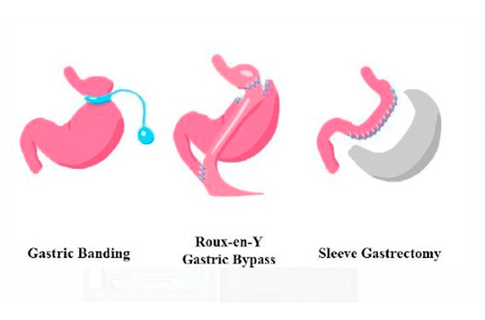 Embolization procedure — bariatric embolization procedure and its effectiveness uncovered featured image | Prof. Dr. Imtiaz Ahmad, interventional radiologi