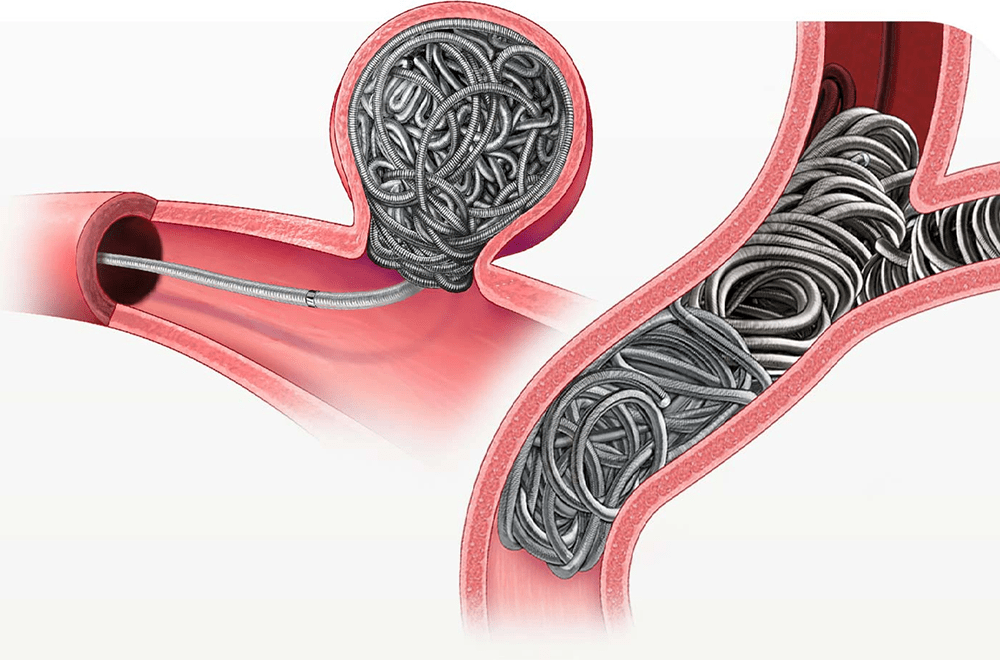 Embolization procedure — coil embolization a closer look at the procedure featured image | Prof. Dr. Imtiaz Ahmad, interventional radiologist Pakistan