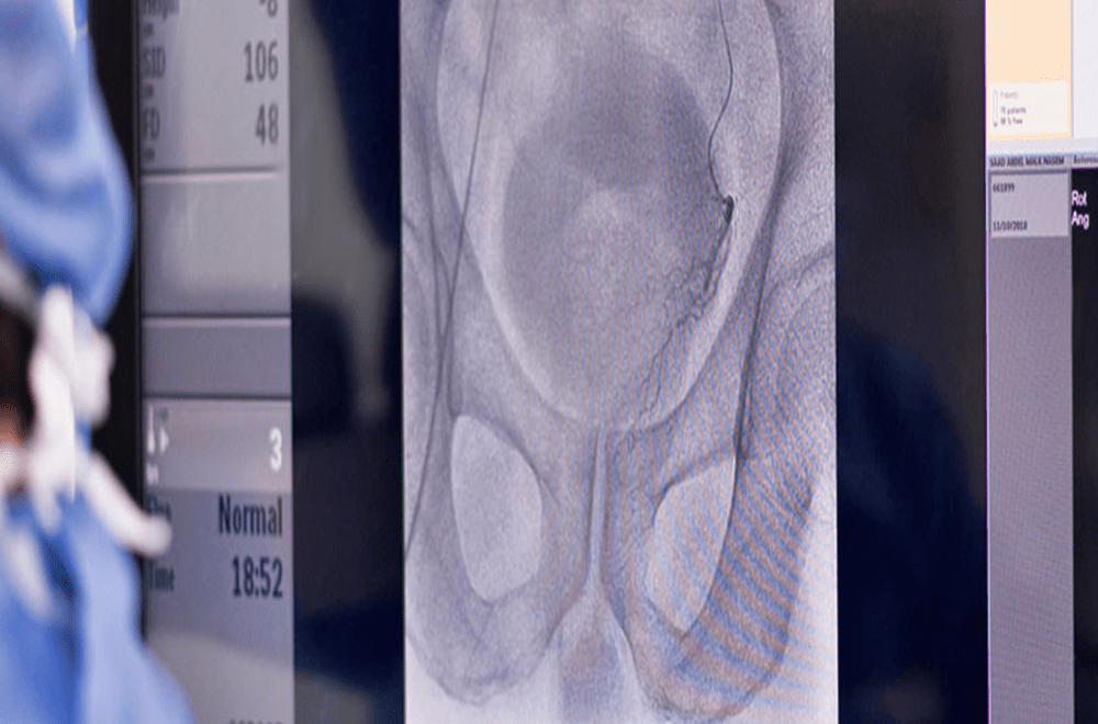 Embolization procedure — comprehensive guide to embolization procedures uses and considerations featured image | Prof. Dr. Imtiaz Ahmad, interventional rad