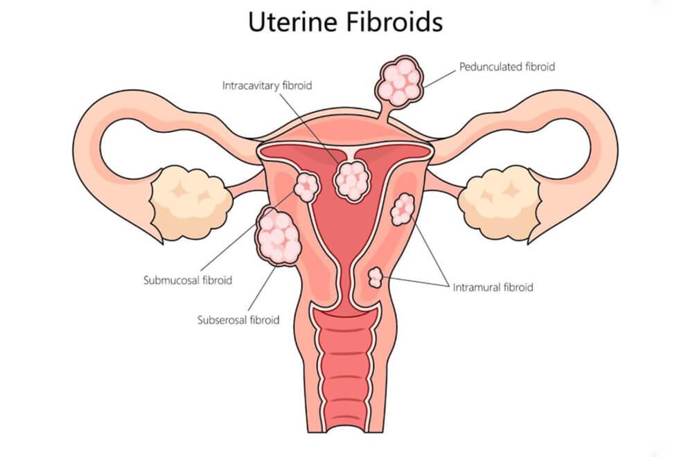 Uterine fibroid embolization (UFE) — difference between fibroids and cysts symptoms causes treatment featured image | Prof. Dr. Imtiaz Ahmad, interventiona