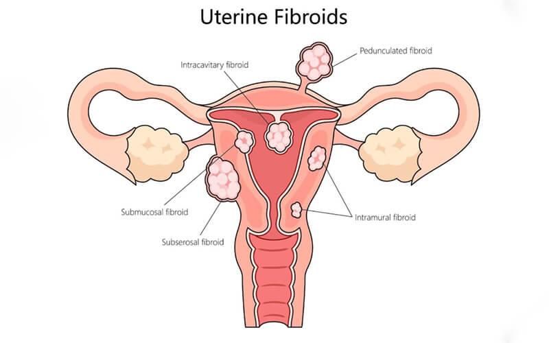 Uterine fibroid embolization (UFE) — difference between fibroids and cysts symptoms causes treatment image one | Prof. Dr. Imtiaz Ahmad, interventional rad