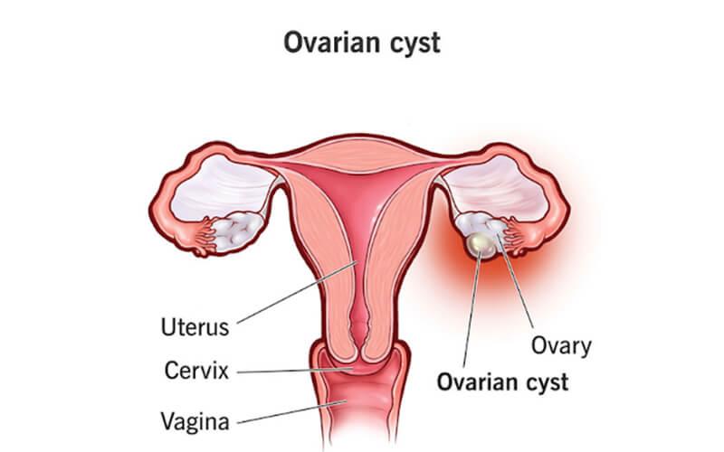 Uterine fibroid embolization (UFE) — difference between fibroids and cysts symptoms causes treatment image two | Prof. Dr. Imtiaz Ahmad, interventional rad