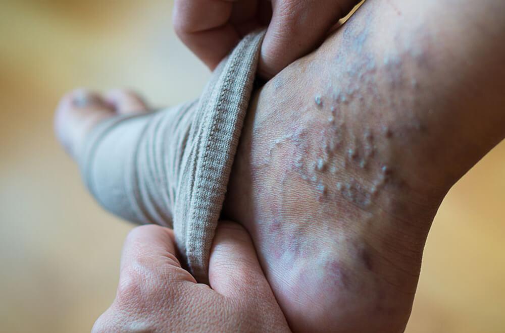 Varicose vein treatment — early signs of varicose veins you need to know featured image | Prof. Dr. Imtiaz Ahmad, interventional radiologist Pakistan