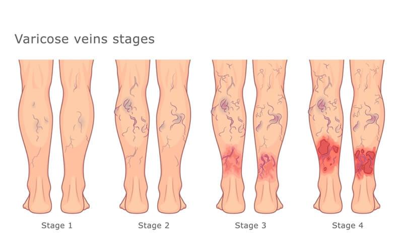 Varicose vein treatment — early signs of varicose veins you need to know image one | Prof. Dr. Imtiaz Ahmad, interventional radiologist Pakistan