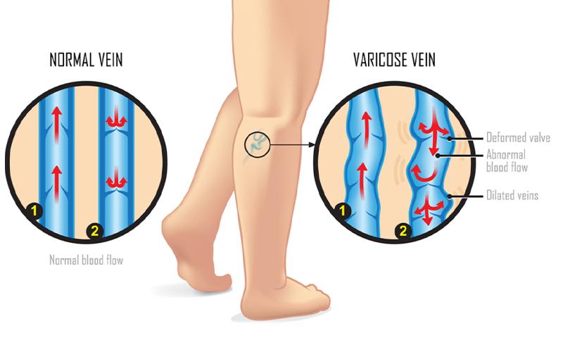 Varicose vein treatment — early signs of varicose veins you need to know image two | Prof. Dr. Imtiaz Ahmad, interventional radiologist Pakistan