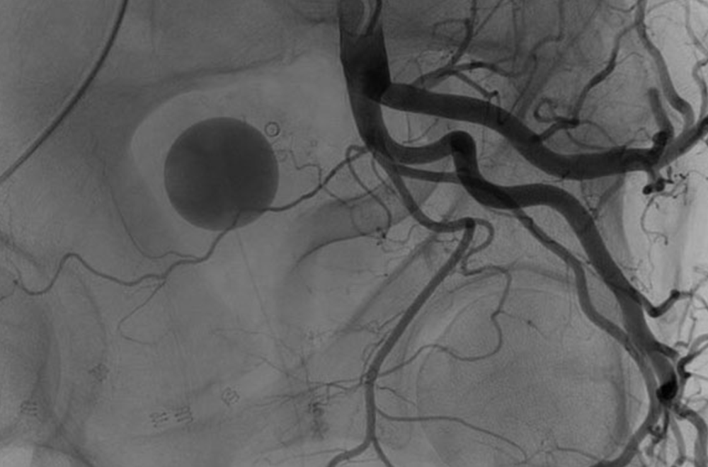 Prostate artery embolization — exploring prostate artery embolization duration and benefits featured image | Prof. Dr. Imtiaz Ahmad, interventional radiolo
