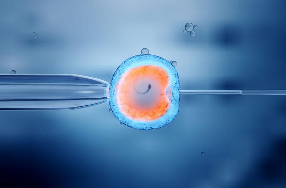 Varicocele embolization — the impact of treating varicocele on ivf success featured image | Prof. Dr. Imtiaz Ahmad, interventional radiologist Pakistan