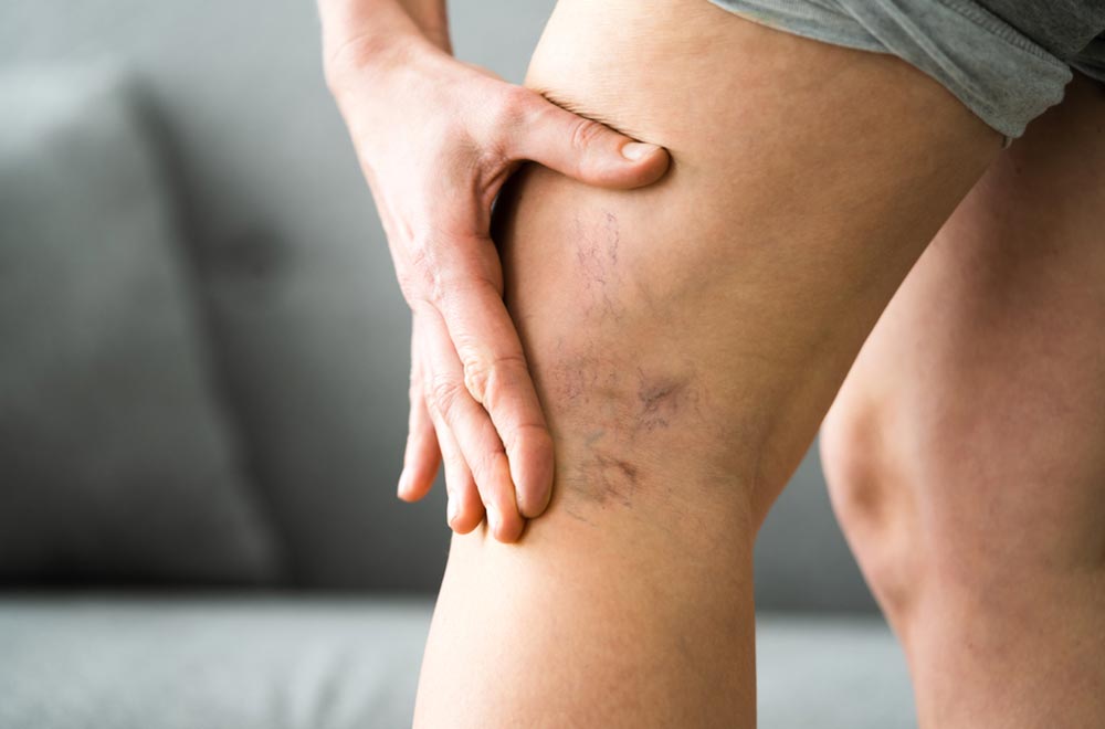 Varicose vein treatment — treatreatment of varicose veins improves your mobility and endurance featured image | Prof. Dr. Imtiaz Ahmad, interventional radi