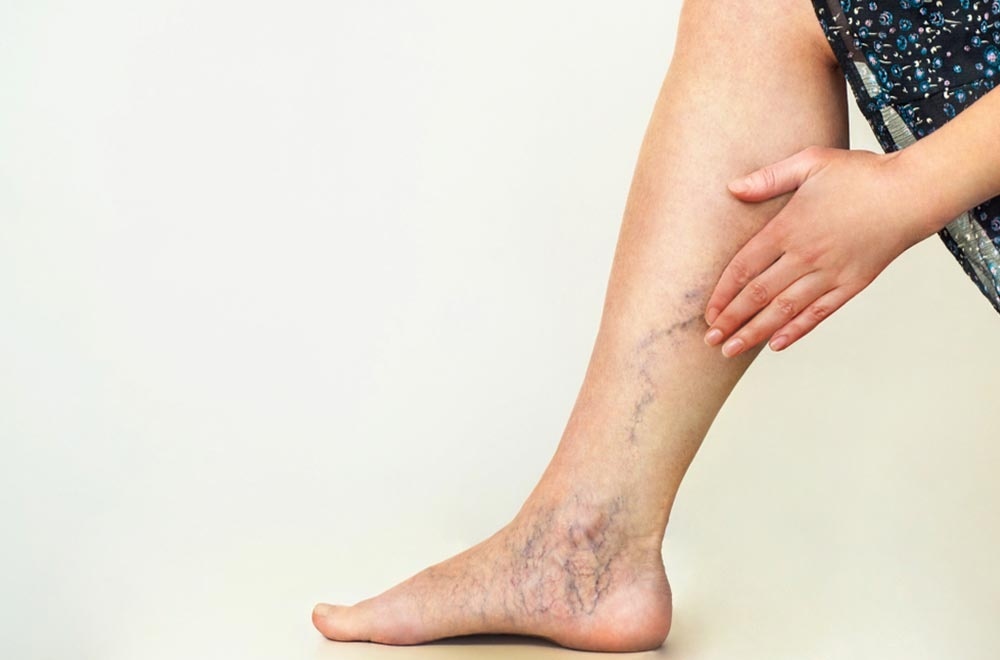 Varicose vein treatment — varicose veins a growing concern in the muslim society featured image | Prof. Dr. Imtiaz Ahmad, interventional radiologist Pakist