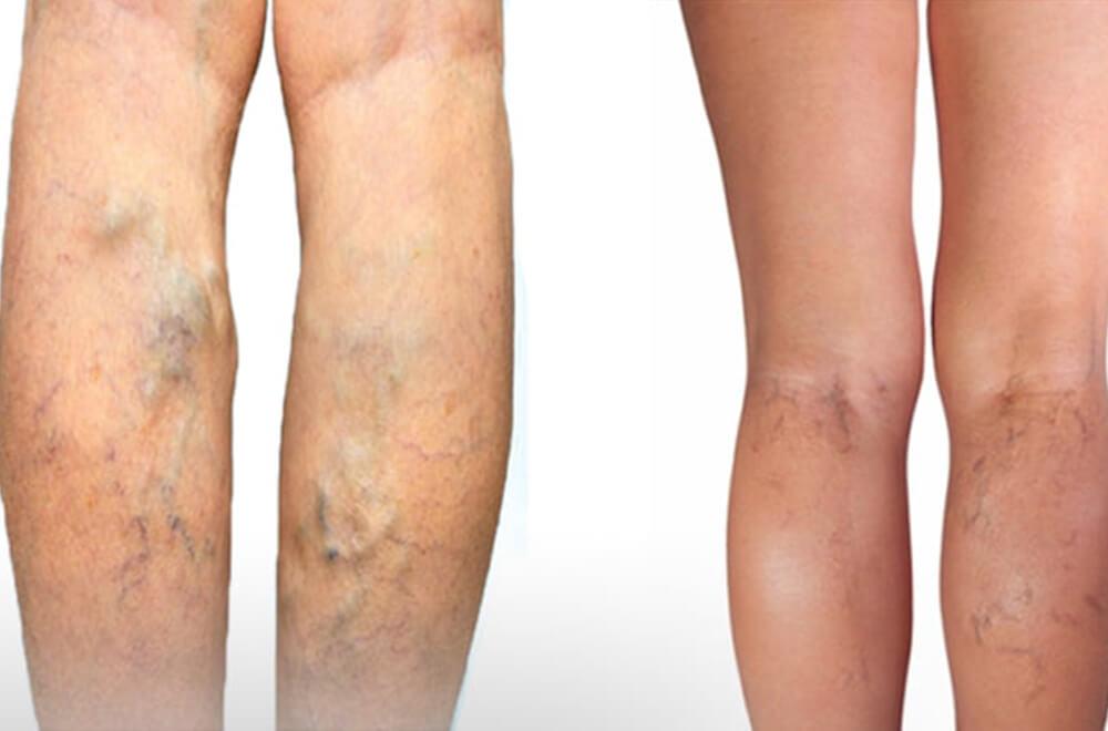 Varicose vein treatment — what is the difference between varicose and spider veins featured image | Prof. Dr. Imtiaz Ahmad, interventional radiologist Paki